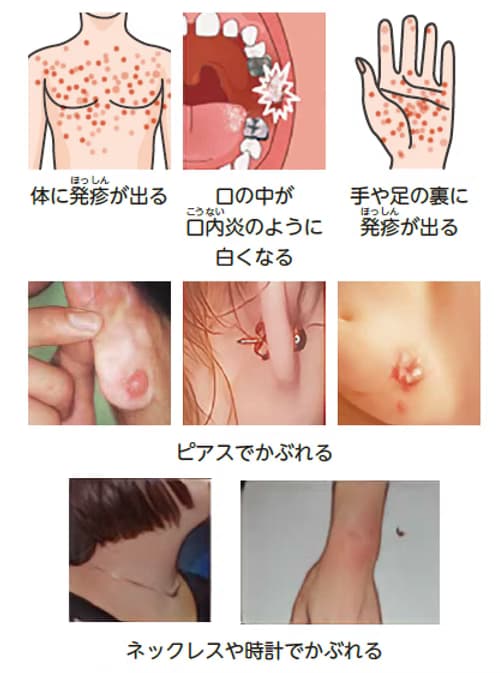 Symptoms